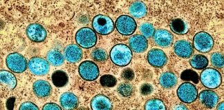 Monkeypox virus, simian smallpox